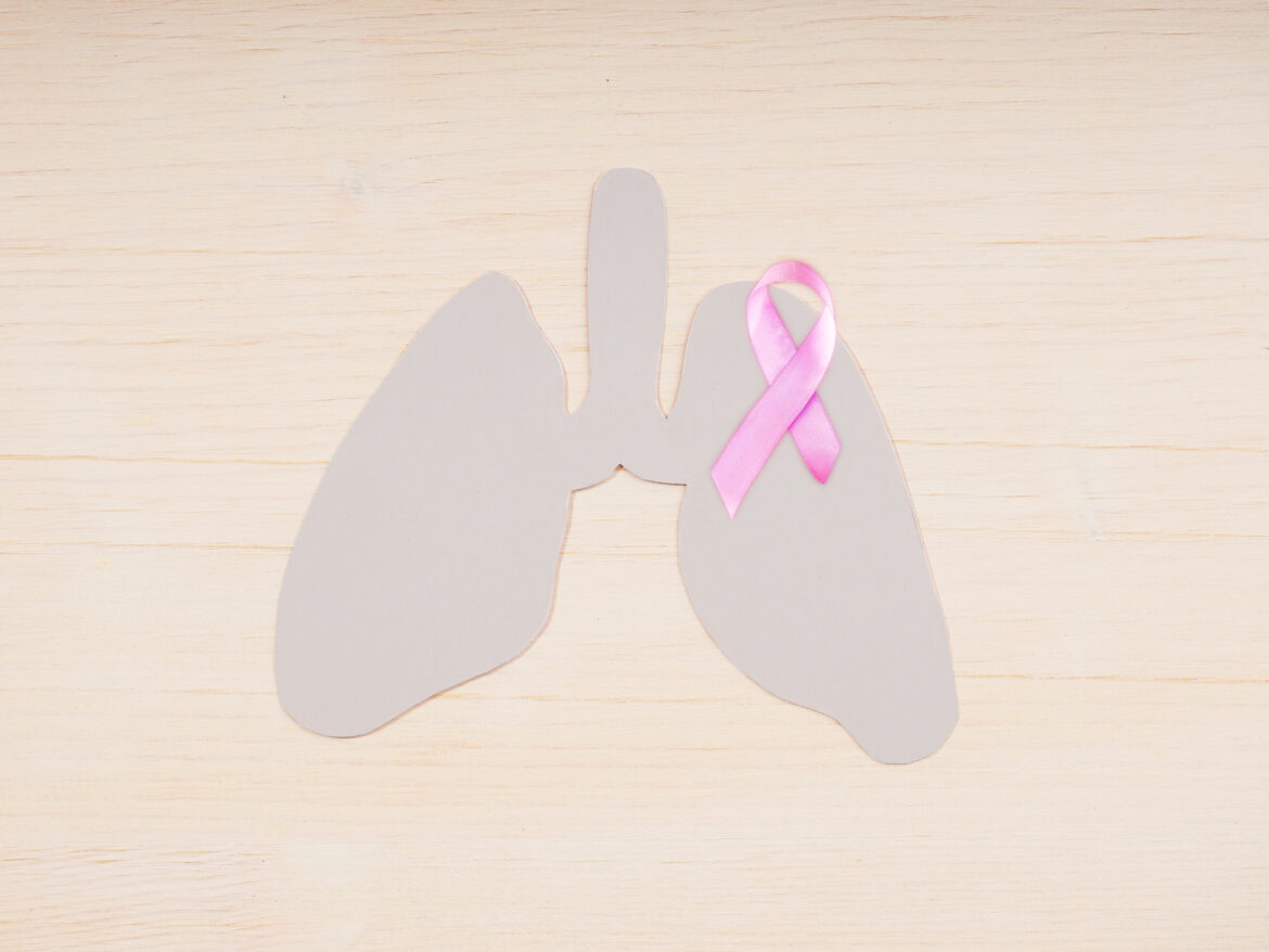 Cancer du poumon : la lutte passe par le dépistage