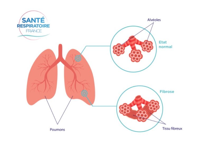 Fibrose pulmonaire - Association Santé Respiratoire France